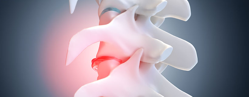 patient needing degenerative disc disease in need of spinal decompression therapy in Camp Springs