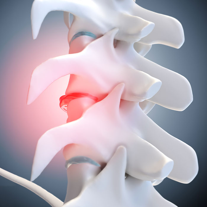 degenerative Disc Disease treatment in Camp Springs