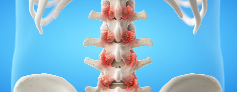 patient needing facet joint syndrome in need of spinal decompression therapy in Camp Springs