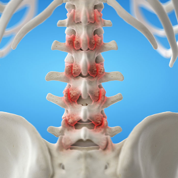 facet Joint Syndrome treatment in Camp Springs