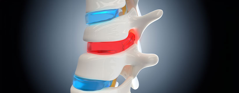 patient needing herniated disc in need of spinal decompression therapy in Camp Springs