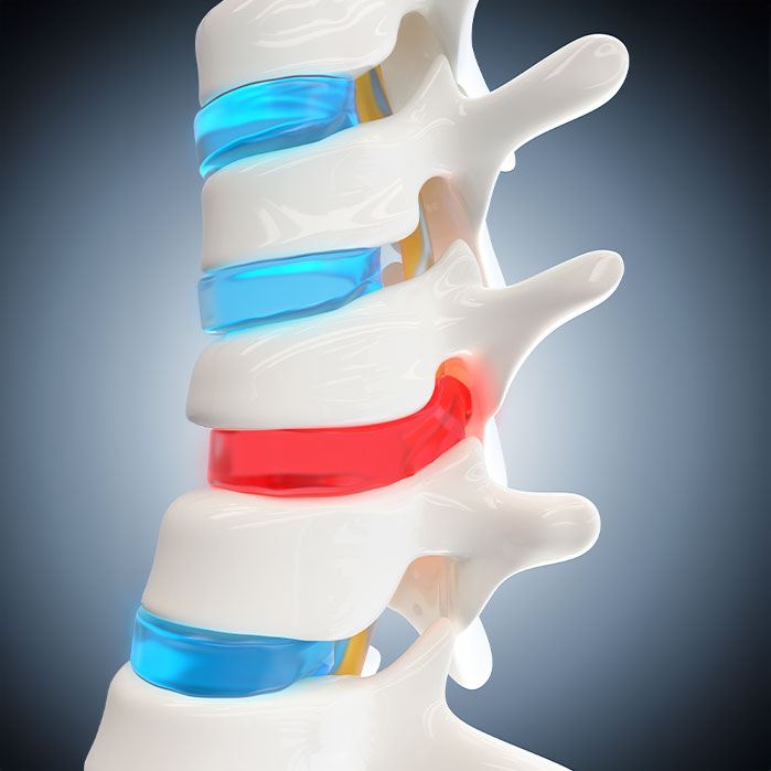 herniated Disc treatment in Camp Springs