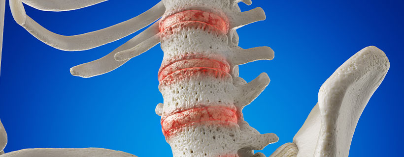 patient needing osteoarthritis in need of spinal decompression therapy in Camp Springs