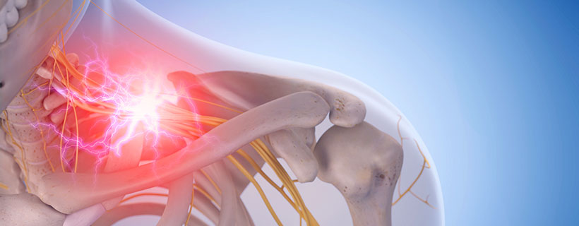 patient needing pinched nerve in need of spinal decompression therapy in Camp Springs