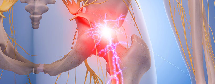 patient needing sciatica in need of spinal decompression therapy in Camp Springs