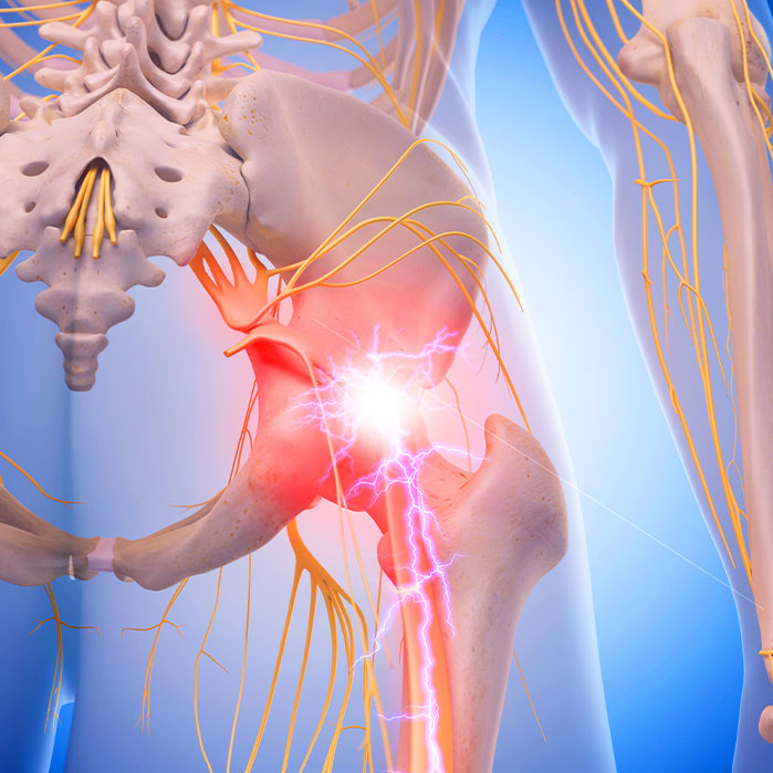 sciatica treatment in Camp Springs