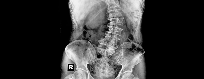 patient needing scoliosis in need of spinal decompression therapy in Camp Springs