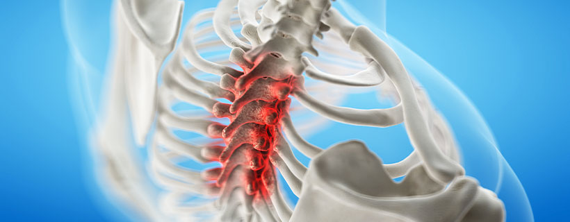 patient needing spinal stenosis in need of spinal decompression therapy in Camp Springs