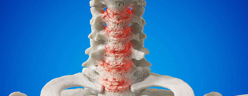 patient needing spondylosis  in need of spinal decompression therapy in Camp Springs