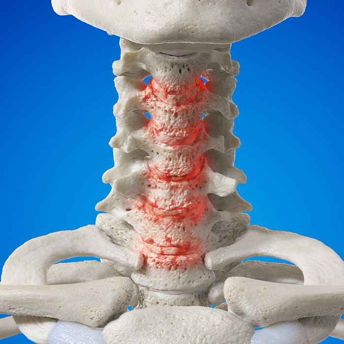 spondylosis treatment in Camp Springs
